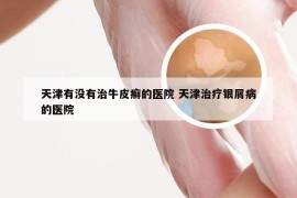 天津有没有治牛皮癣的医院 天津治疗银屑病的医院