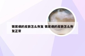 银屑病的皮肤怎么恢复 银屑病的皮肤怎么恢复正常