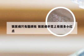 银屑病只有胳膊有 银屑病手臂上有很多小红点