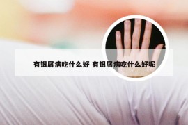 有银屑病吃什么好 有银屑病吃什么好呢