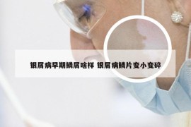 银屑病早期鳞屑啥样 银屑病鳞片变小变碎