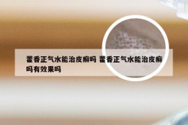 藿香正气水能治皮癣吗 藿香正气水能治皮癣吗有效果吗