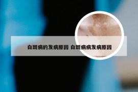 白斑病的发病原因 白斑病病发病原因