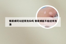 银屑病可以经常洗头吗 银屑病能不能经常洗澡