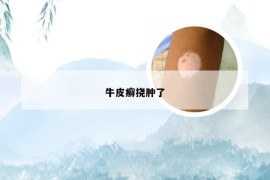 牛皮癣挠肿了