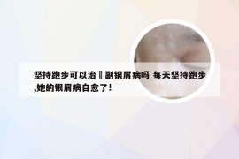 坚持跑步可以治癒副银屑病吗 每天坚持跑步,她的银屑病自愈了!