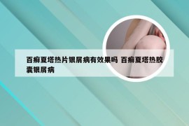 百癣夏塔热片银屑病有效果吗 百癣夏塔热胶囊银屑病