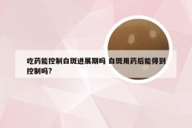吃药能控制白斑进展期吗 白斑用药后能得到控制吗?