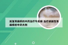 反复荨麻疹的中药治疗牛皮癣 治疗顽固性荨麻疹的中药方剂
