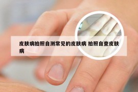 皮肤病拍照自测常见的皮肤病 拍照自查皮肤病