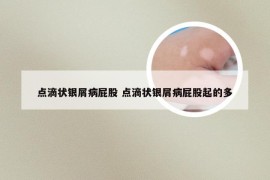 点滴状银屑病屁股 点滴状银屑病屁股起的多