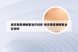 南京银屑病哪里治疗的好 南京银屑病哪里治比较好