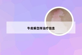 牛皮癣怎样治疗信息