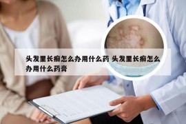 头发里长癣怎么办用什么药 头发里长癣怎么办用什么药膏