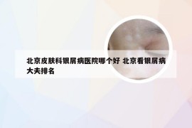 北京皮肤科银屑病医院哪个好 北京看银屑病大夫排名