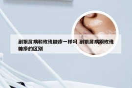 副银屑病和玫瑰糠疹一样吗 副银屑病跟玫瑰糠疹的区别