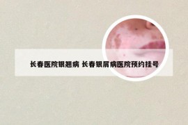 长春医院银翘病 长春银屑病医院预约挂号