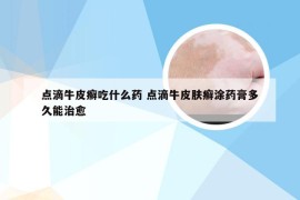 点滴牛皮癣吃什么药 点滴牛皮肤癣涂药膏多久能治愈