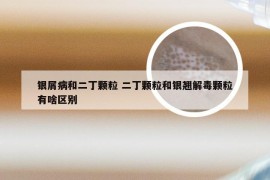 银屑病和二丁颗粒 二丁颗粒和银翘解毒颗粒有啥区别