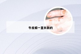 牛皮癣一直长新的