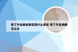 得了牛皮癣皮肤出现什么症状 得了牛皮病癣怎么办