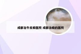 成都治牛皮癣医院 成都治癣的医院