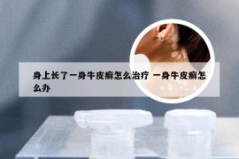身上长了一身牛皮癣怎么治疗 一身牛皮癣怎么办