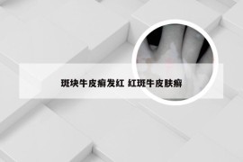 斑块牛皮癣发红 红斑牛皮肤癣