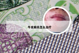 牛皮癣炎怎么治疗