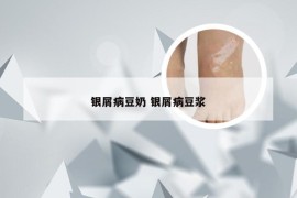 银屑病豆奶 银屑病豆浆