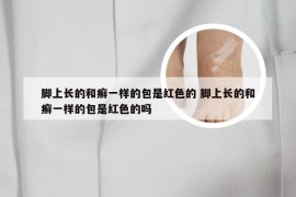 脚上长的和癣一样的包是红色的 脚上长的和癣一样的包是红色的吗