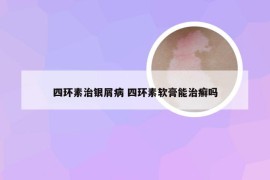 四环素治银屑病 四环素软膏能治癣吗