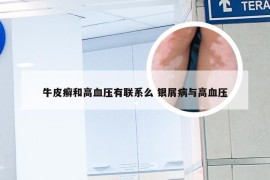 牛皮癣和高血压有联系么 银屑病与高血压