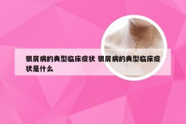 银屑病的典型临床症状 银屑病的典型临床症状是什么