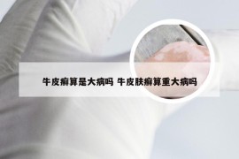 牛皮癣算是大病吗 牛皮肤癣算重大病吗