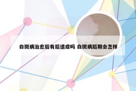 白斑病治愈后有后遗症吗 白斑病后期会怎样