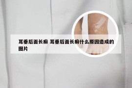耳垂后面长癣 耳垂后面长癣什么原因造成的图片