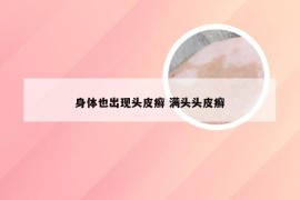 身体也出现头皮癣 满头头皮癣