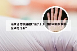 湿疹还是银屑病好治么》》 湿疹与银屑病的区别是什么?