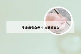 牛皮癣变白色 牛皮肤癣变白
