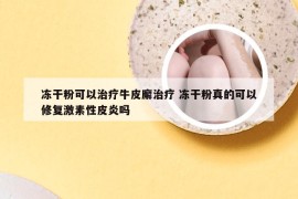 冻干粉可以治疗牛皮廨治疗 冻干粉真的可以修复激素性皮炎吗