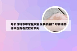 呼和浩特市哪家医院看皮肤病最好 呼和浩特哪家医院看皮肤看的好
