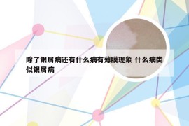 除了银屑病还有什么病有薄膜现象 什么病类似银屑病