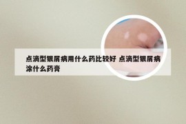 点滴型银屑病用什么药比较好 点滴型银屑病涂什么药膏