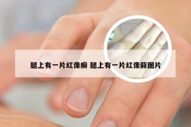腿上有一片红像癣 腿上有一片红像藓图片