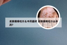 皮肤瘙痒吃什么中药最好 皮肤瘙痒吃什么中药?