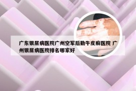 广东银屑病医院广州空军后勤牛皮癣医院 广州银屑病医院排名哪家好