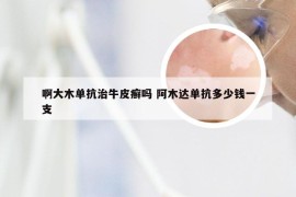 啊大木单抗治牛皮癣吗 阿木达单抗多少钱一支
