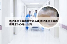 嘴巴里面有白斑很疼怎么办 嘴巴里面有白斑很疼怎么办吃什么药
