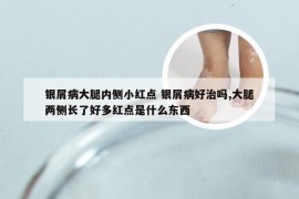 银屑病大腿内侧小红点 银屑病好治吗,大腿两侧长了好多红点是什么东西